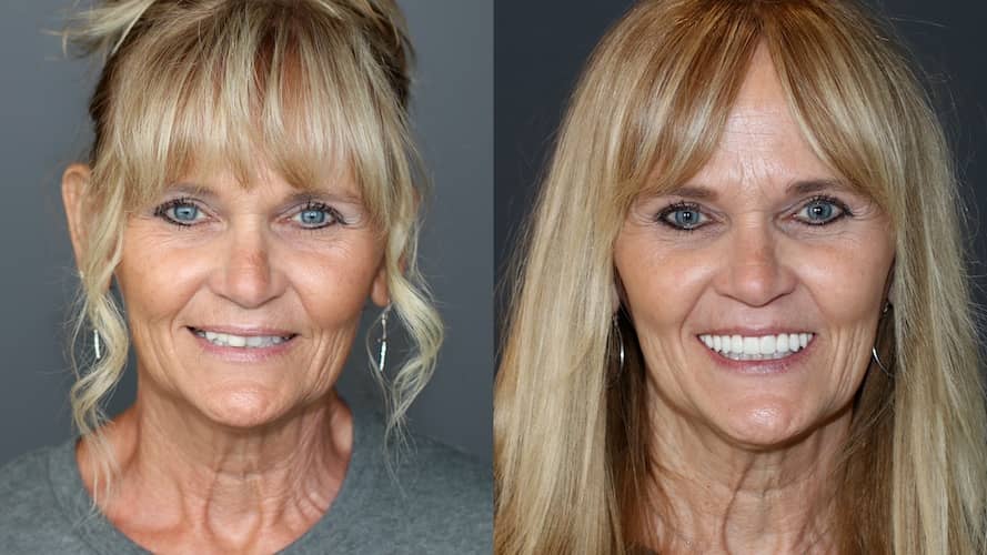 Innovative Implant Smile before and after.