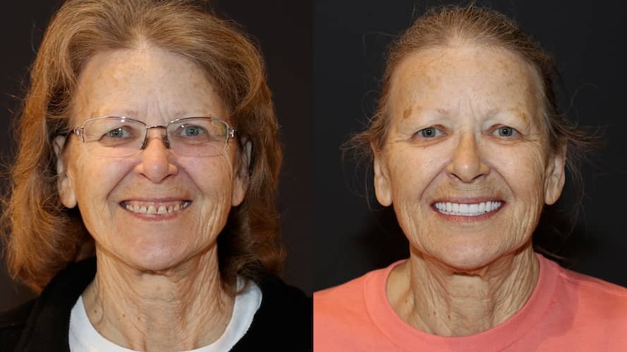Innovative Implant Smile before and after.